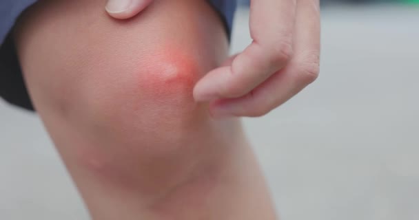 Homme gratter démangeaisons moustique bosse — Video