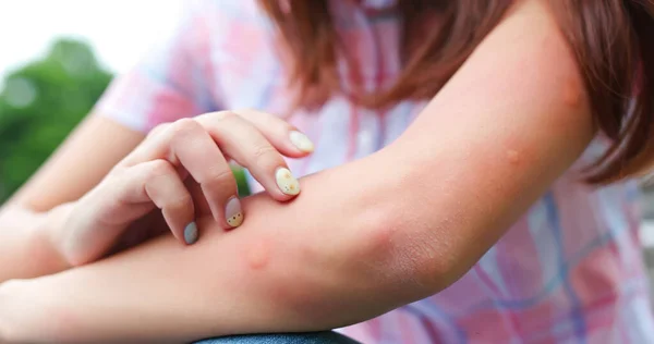Arm Gilr Bitten Mosquito Get Bumps Her Skin Summer — Stock Photo, Image