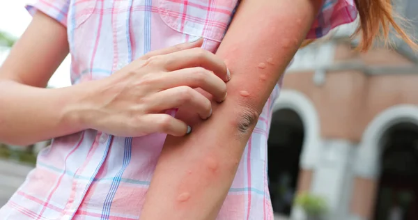 Brazo Gilr Picado Por Mosquito Recibe Protuberancias Piel Verano — Foto de Stock