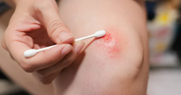 Closeup Using Cotton Swab Apply Ointment Knee Gently Which Get — Stock Photo, Image