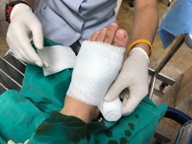 Cerrah ameliyathanede bir adamın ayağına ameliyat yapıyor. Doktor tıbbi aletler kullanıyor. Kelepçe ve cımbız kullanıyor.. 