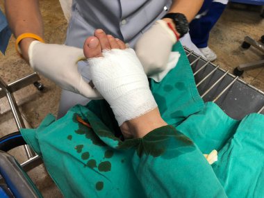 Cerrah ameliyathanede bir adamın ayağına ameliyat yapıyor. Doktor tıbbi aletler kullanıyor. Kelepçe ve cımbız kullanıyor.. 