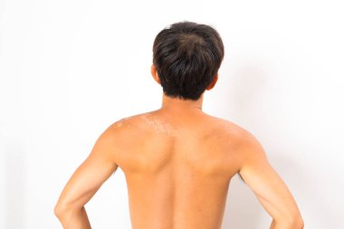 Yüzme ve güneş kremi sürmeden güneşe maruz kalma nedeniyle kuru deri soyuluyor.