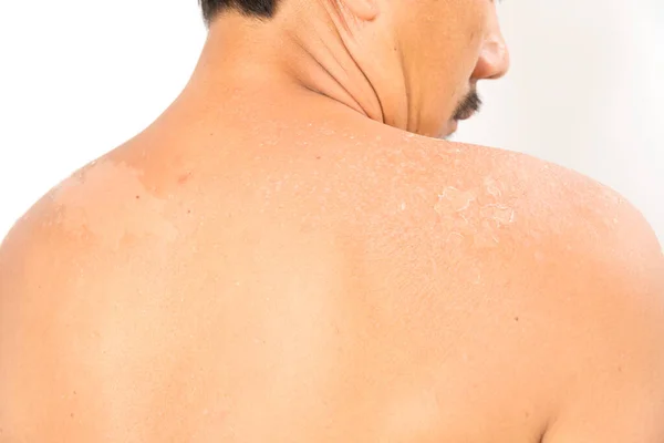 Espalda Hombre Con Piel Quemada Sol Brillante Piel Quemada Por —  Fotos de Stock