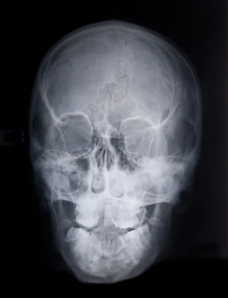 Rayos X de un cráneo deformado — Foto de Stock