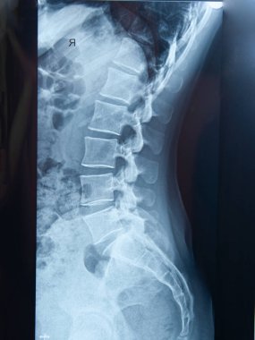 Omurganın beyaz arka planda izole edilmiş tıbbi röntgeni.