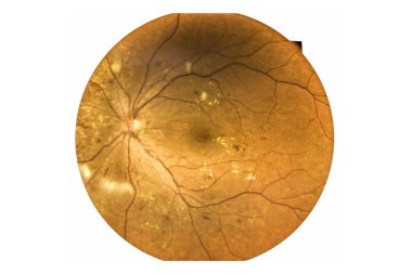 Fundus fotoğrafçılığı Madical Retina Anormal beyaz arka planda izole edildi. Diyabet Retinası sağlık hizmetleri kavramını kontrol ediyor.