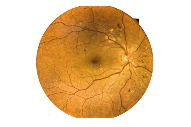 Fundus photography Madical Retina Abnormal isolated on white background.Retina of diabetes check up medical healthcare concept. clipart