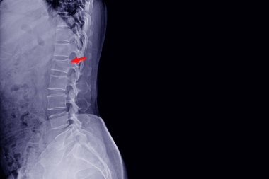 Omurga röntgeni, erkek kazasının ve siyah ağrının omurga kırığının L1 olduğunu gösteriyor. Normal disk alanları ve paravertebral yumuşak doku. Tıbbi konsept..