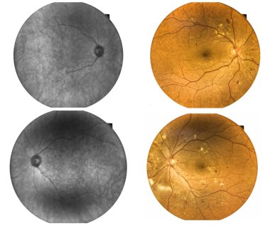 Fundus photography Madical Retina IR and color Abnormal isolated on white background.Retina of diabetes check up medical healthcare concept. clipart