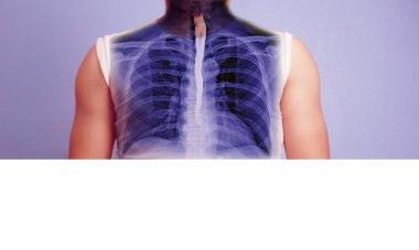 Baryum kırlangıcı tozu özel muayenesi. Esophagram ve Baryum, hastanın yemek borusu gösteren bir sıvı içmesinden sonra AP görüşünü yutar..