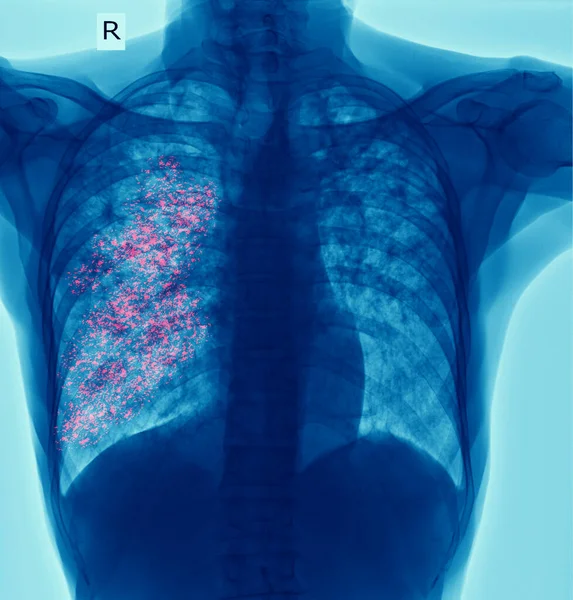 Грудна Кров Показує Порожнину Правої Легені Інтерстиціальну Інфільтрацію Обох Легенів — стокове фото