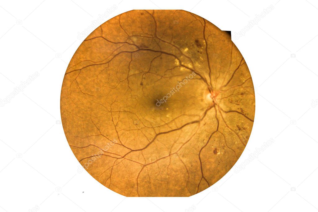 Fundus photography Madical Retina Abnormal isolated on white background.Retina of diabetes check up medical healthcare concept.