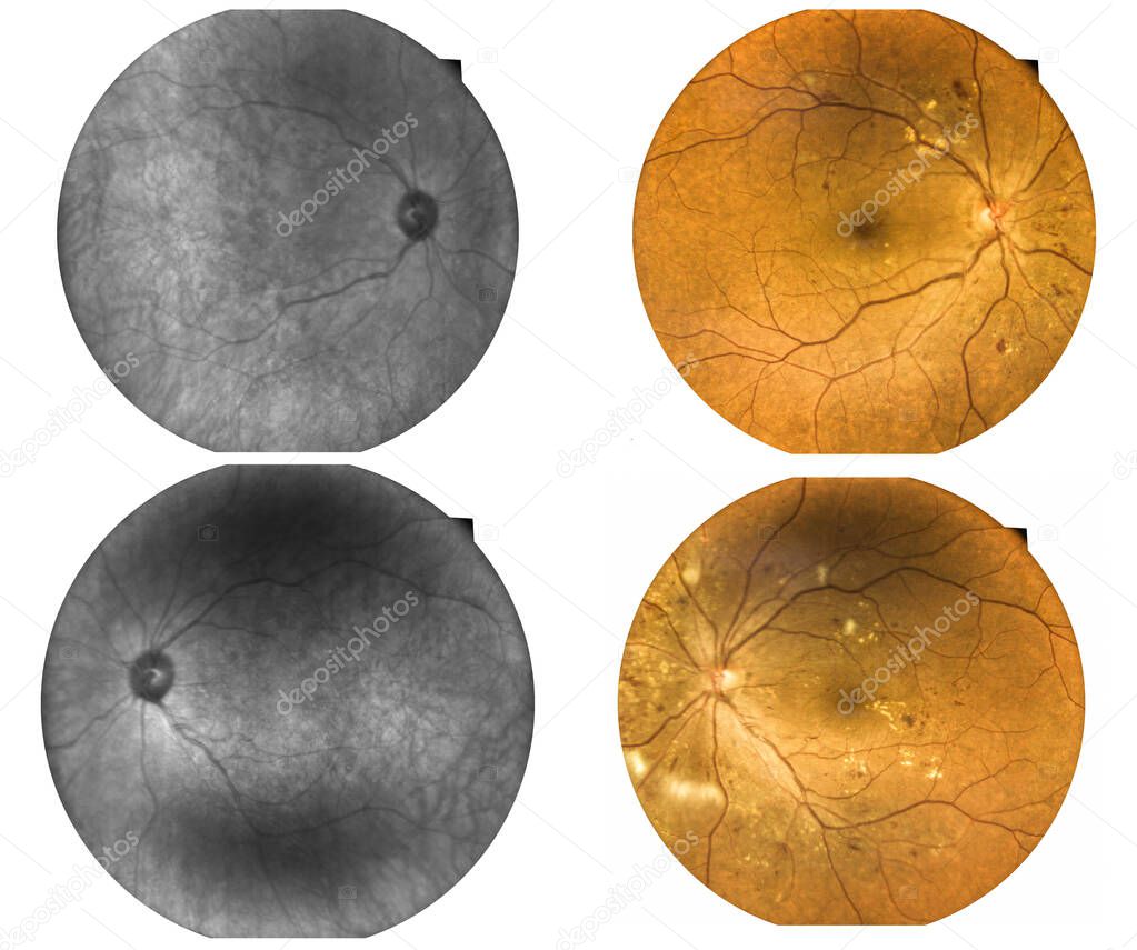 Fundus photography Madical Retina IR and color Abnormal isolated on white background.Retina of diabetes check up medical healthcare concept.