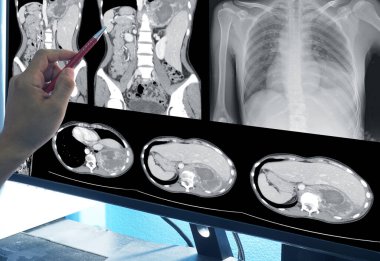 Ciğerlerin zatürree ya da koronavirüs hastalığı olan bilgisayarlı tomografisi üzerinde el doktorluğu noktasını kapat. Yüksek çözünürlük Coronavirus covid19 konsepti..