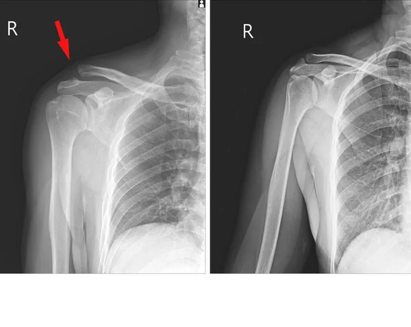 Röntgen Der Rechten Schulter Subluation Der Akromioklavikuläre Gelenkverletzung Und Normales — Stockfoto
