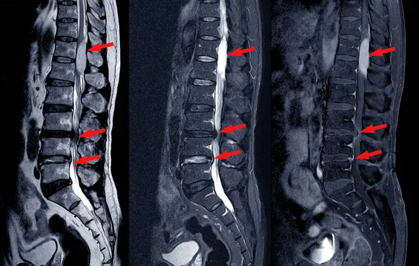 T12 L1级脊柱肿块患者腰椎骨刺Mri扫描严重膨胀性L3 4型椎间盘突出 导致双侧L4型神经根压和箭头端椎管狭窄 — 图库照片