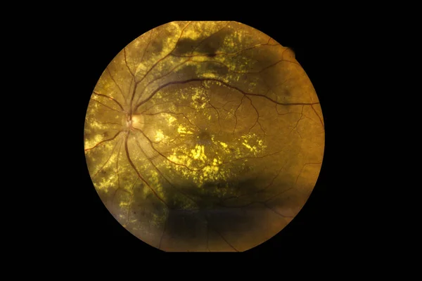Pohled Dovnitř Lidských Očních Onemocnění Ukazujících Sítnici Oční Nerv Makulu — Stock fotografie