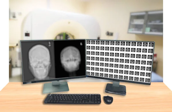 Image Douce Floue Tomodensitométrie Tdm Cerveau Avec Opacifiants Sur Écran — Photo