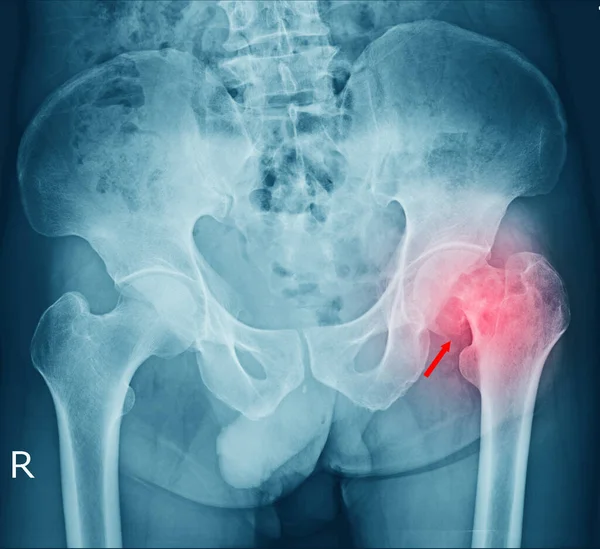Film Ray Een Mannelijke Bekken Fractuur Artritis Bij Linker Heup — Stockfoto
