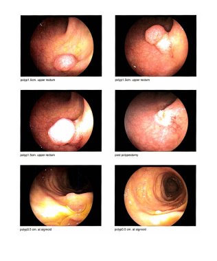 Medical image Gastrointestinal endoscopic examination image,Finding polyp upper rectum and sigmoid with post polypectomy Image contains excessive noise, film grain, compression artifacts when full solution. clipart