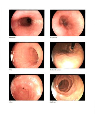 Gastrointestinal endoskopik muayene, yemek borusu, EG kavşağı, vücut, fundus, antrum, duodenum normal tam çözelti sırasında aşırı gürültü, film tahılı, sıkıştırma objeleri içerir..
