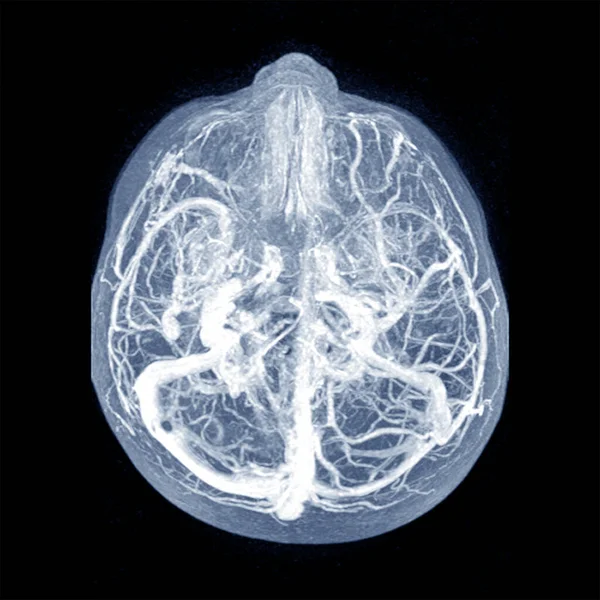 Irm Brain Œdème Vasogénique Périlésional Modéré Avec Décalage Médian Côté — Photo