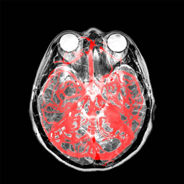 Arm Angiorressonância Magnética Cérebro Para Paciente Acidente Vascular Cerebral Detecção — Fotografia de Stock