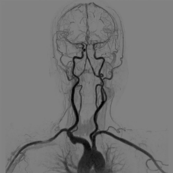 Mra Magnetická Rezonance Angiografie Mozku Pro Pacienta Mozkovou Příhodou Nebo — Stock fotografie
