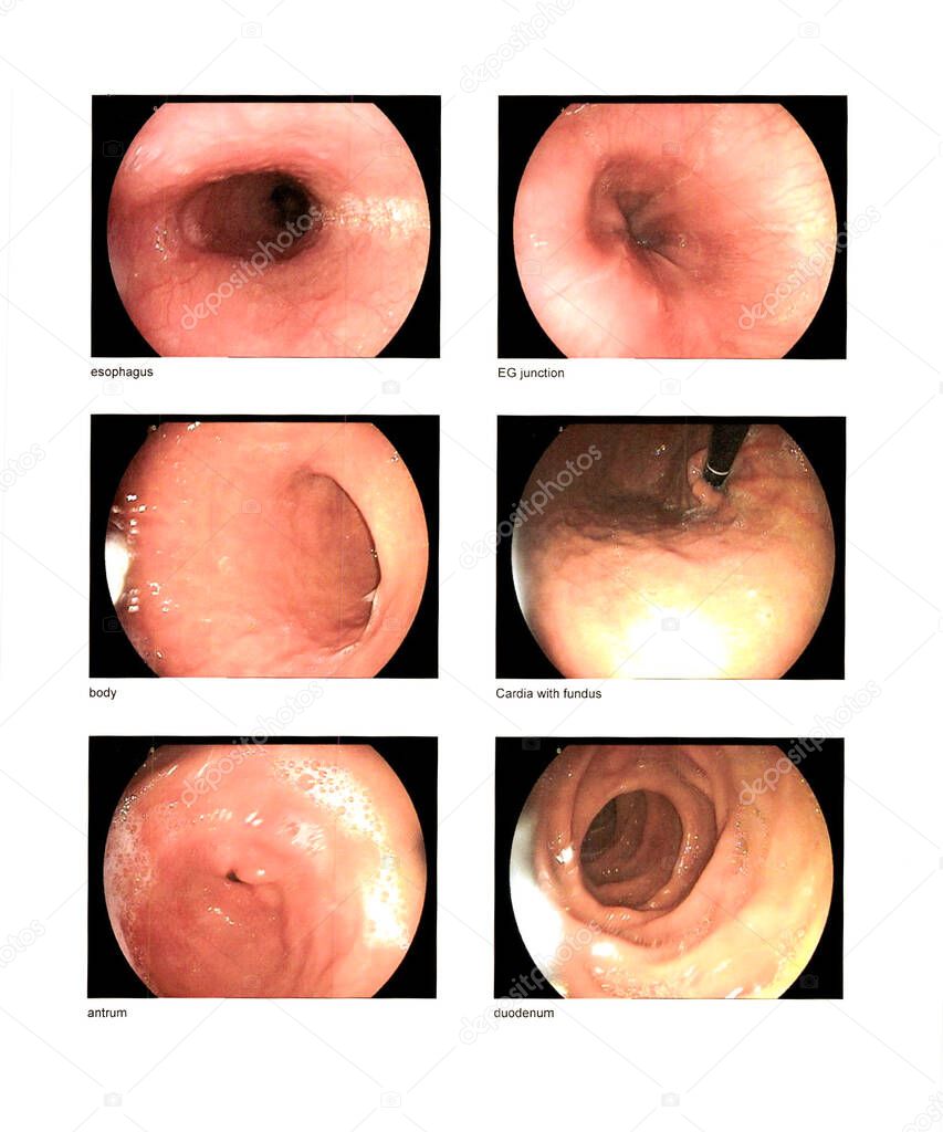 Gastrointestinal endoscopic examination,Finding esophagus,EG junction,body,cardia with fundus,antrum,duodenum normal  contains excessive noise, film grain, compression artifacts when full solution.