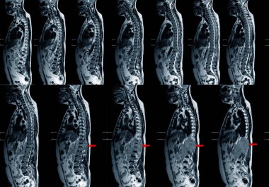 Tüm omurga T2W sagittal düzlem MRI koleksiyonu Tanısal Omurilik Sıkıştırma ve tümör için.