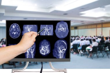 Beyin MR 'ı ya da beyindeki el doktoruyla yapılan beyin arterinin manyetik rezonans anjiyografisi beyindeki anormal kan kan damarlarını gösterdi. Tıp konferansı ve sağlık konsepti.