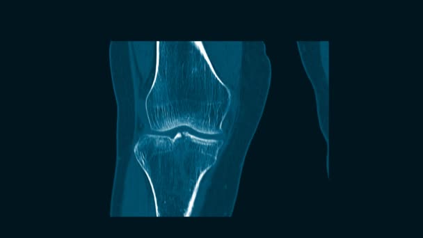 X-ray Knee Showing Epipyseal and fracture lateral proximal tibia include tibia eminence with joint effusion. — Stock Video