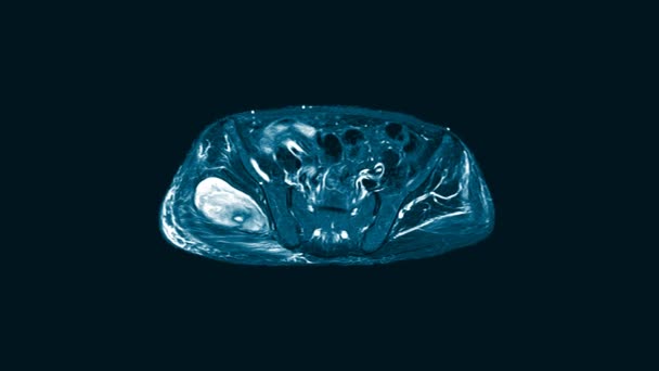 MRI OF THE THORACOLUMBAR SPINE: 30letá žena s retroperitoneální hmotou, která vylučuje TBC páteř.. — Stock video