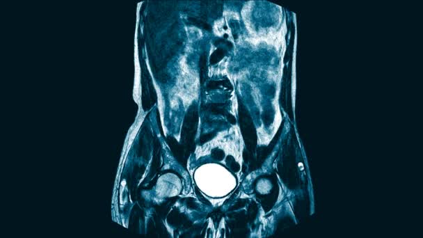 MRI A THORACOLUMBAR SPINE: egy 30 éves nő nyomott retroperitoneális tömeg, hogy kizárják a TBC spine.Medical egészségügyi kép koncepció. — Stock videók