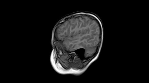 脑CT扫描的闭塞。医疗、科学和教育背景。磁共振成像. — 图库视频影像