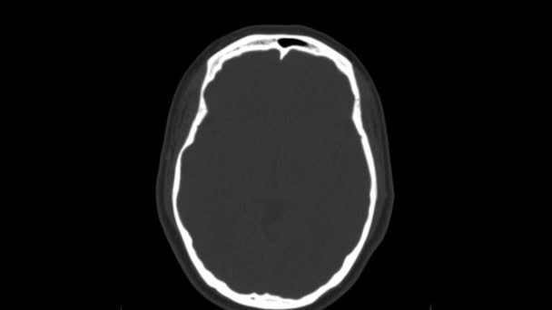 Nahaufnahme eines CT-Scans mit Gehirn. Medizin, Wissenschaft und Bildung mri Gehirn Hintergrund. Kernspintomographie. — Stockvideo