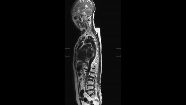 MRI kręgosłupa lędźwiowego Badanie wykazało pęknięte złamanie kręgu L2. — Wideo stockowe