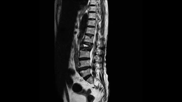 IRM de la colonne vertébrale lombaire L'étude révèle une fracture éclatée du corps vertébral L2. — Video