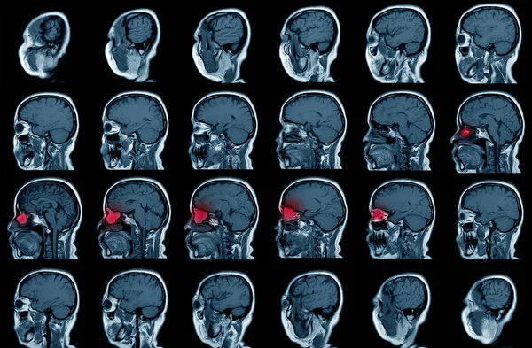 Ressonância Magnética Tumor Visão Sagital Homem Anos Saúde Conceito Médico — Fotografia de Stock