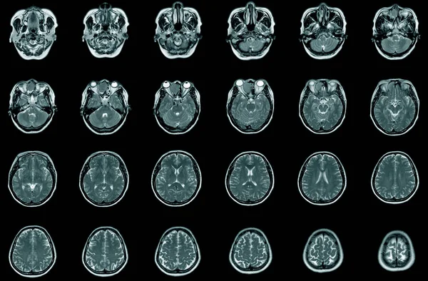 Ressonância Magnética Tumor Visão Transversal Homem Anos Saúde Conceito Médico — Fotografia de Stock