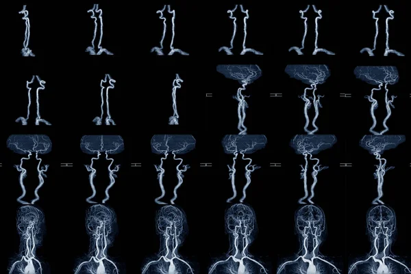 Mra Mri Obraz Naczyń Krwionośnych Mózgu Diagnozy Medycznej Udaru Naczyniowo — Zdjęcie stockowe