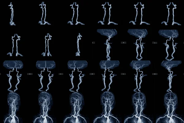 Mra Och Mrt Bild Blodkärl Hjärnan För Medicinsk Diagnos Cerebrovaskulär — Stockfoto