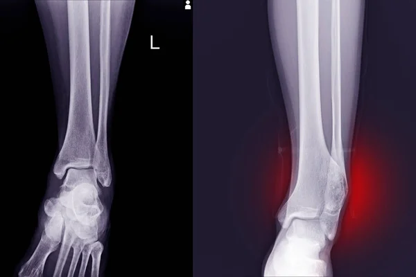 Pie Tobillo Rayos Articulación Normal Osteocondroma Tibia Distal Causan Efecto —  Fotos de Stock