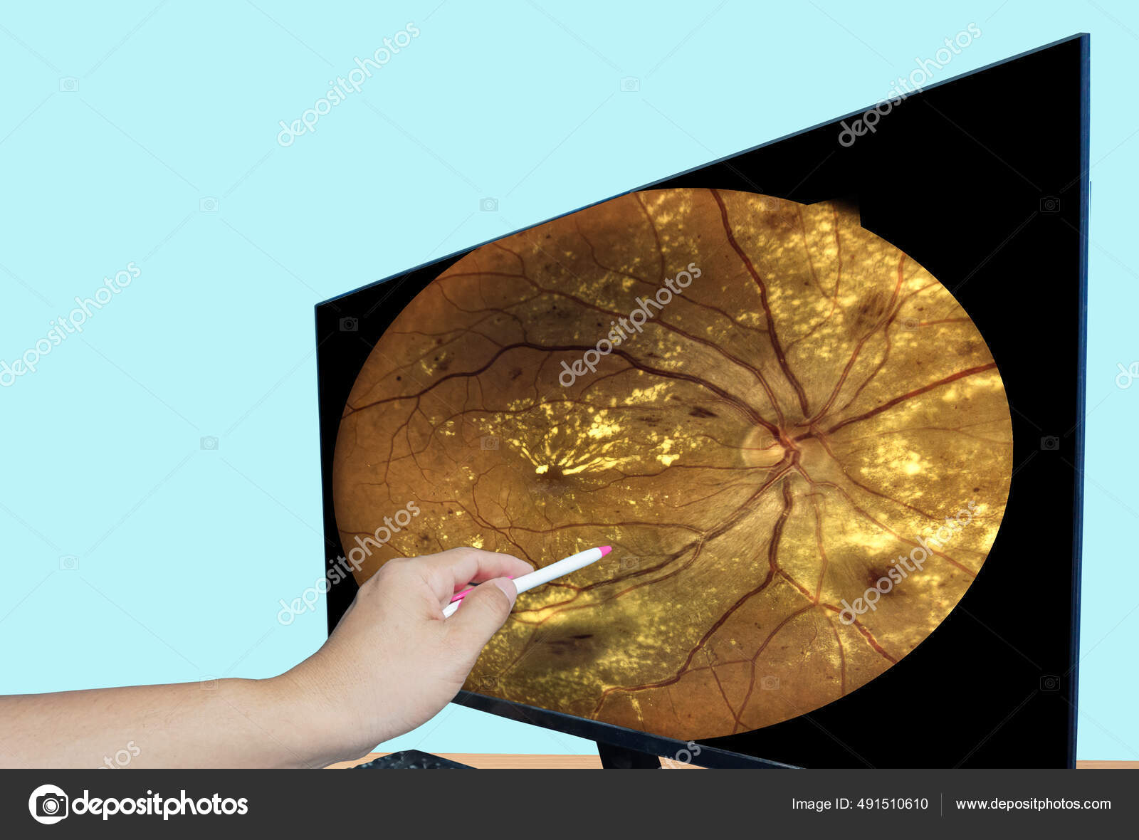 Close Hand Doctor Point Lcd Monitor Report Screen Fundus Photography ...
