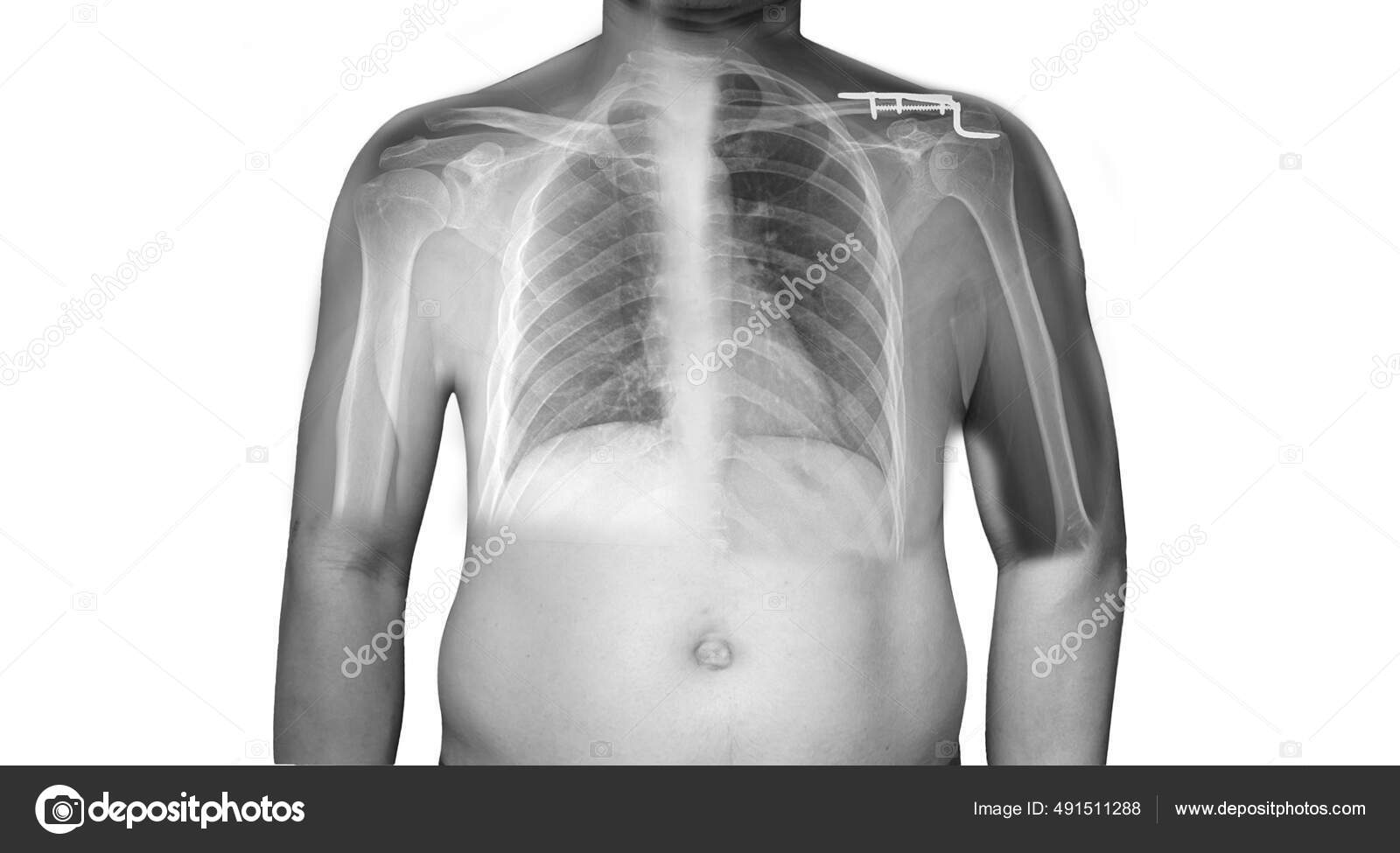 Using 3-Dimensional Fluoroscopy to Assess Acute Clavicle Fracture  Displacement: A Radiographic Study, image size:1600x975