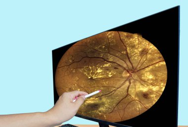 El doktoru noktasını kapatın. LCD monitörü Fundus diyabet görüntülerini görüntüleyin. Tıbbi sağlık konsepti.