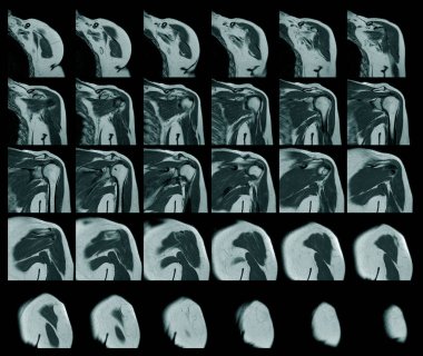Sol omuz döndürme manşet yırtığının manyetik rezonans görüntüsü sol omuz bilimi ve eğitim MRI geçmişi olduğundan şüpheleniliyor..