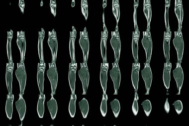 Manyetik Rezonans Görüntüleme (MRI), bacak baldırında tümör ya da kütle gösteren alt ekstremite, tıbbi teknoloji konsepti.