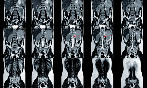 Espinha Ressonância Magnética Mostrando Massa Medula Distal Cone Medular Com — Fotografia de Stock